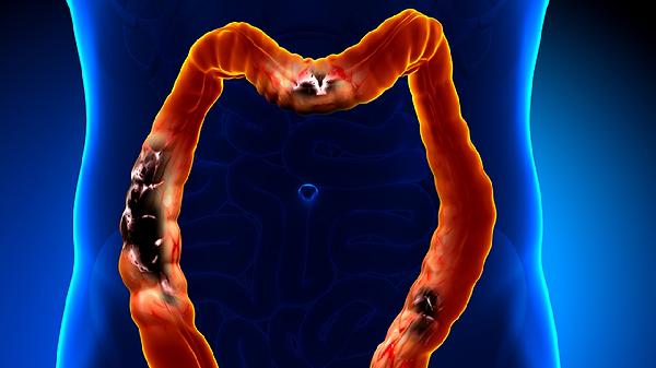 感觉吃了乳癖消不管用,胸越来越疼了,会癌变吗?